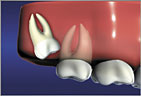 Wisdom Teeth Mesial Impaction